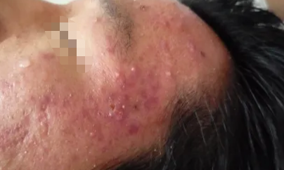 齐齐哈尔治疗面部毛囊炎的医院