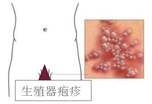 齐齐哈尔生殖器疱疹医院[排行榜齐齐哈尔哪家生殖器疱疹医院