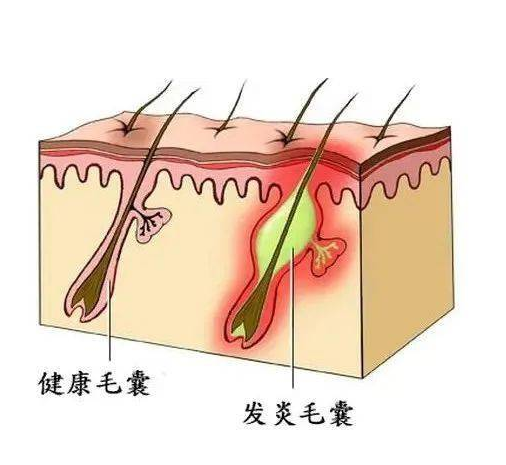 齐齐哈尔治疗毛囊炎的医院哪个好？位置在哪
