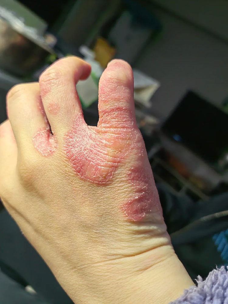 湿疹无踪影，健康零距离！_湿疹对心理有什么影响？如何调节情绪？_齐齐哈尔湿疹医院_齐齐哈尔皮肤病医院