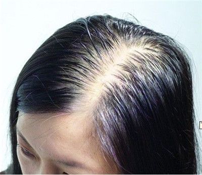防脱发从现在开始，这些小妙招让你头发“固若金汤”_齐齐哈尔防脱发