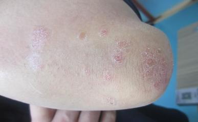 牛皮癣患者如何保护皮肤？这些方法很实用_牛皮癣患者日常该如何保护皮肤？_齐齐哈尔牛皮癣医院_齐齐哈尔皮肤病医院