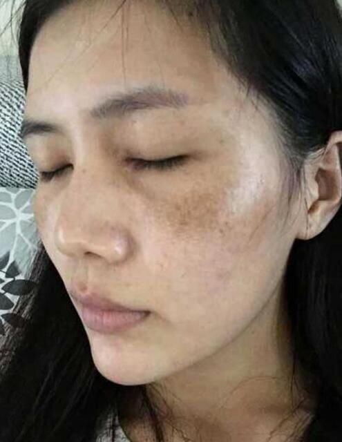 黄褐斑遮不住？90%的人忽略了底层炎症！